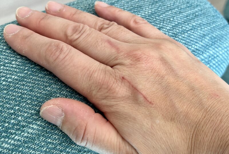 噛まれた傷を放置するのは危険